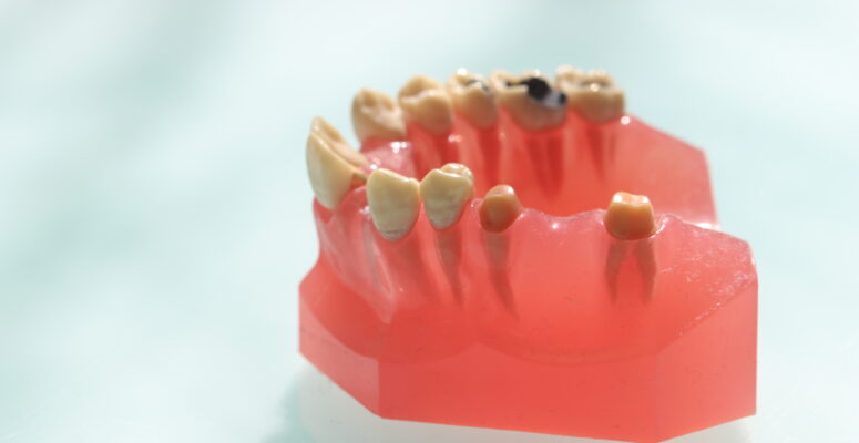 歯茎の模型