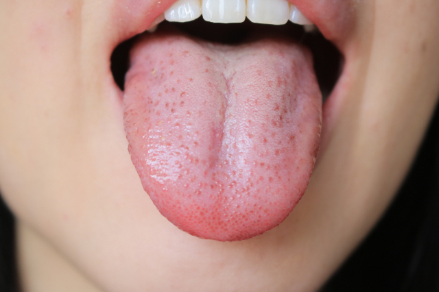 舌 の やけど どれくらい で 治る