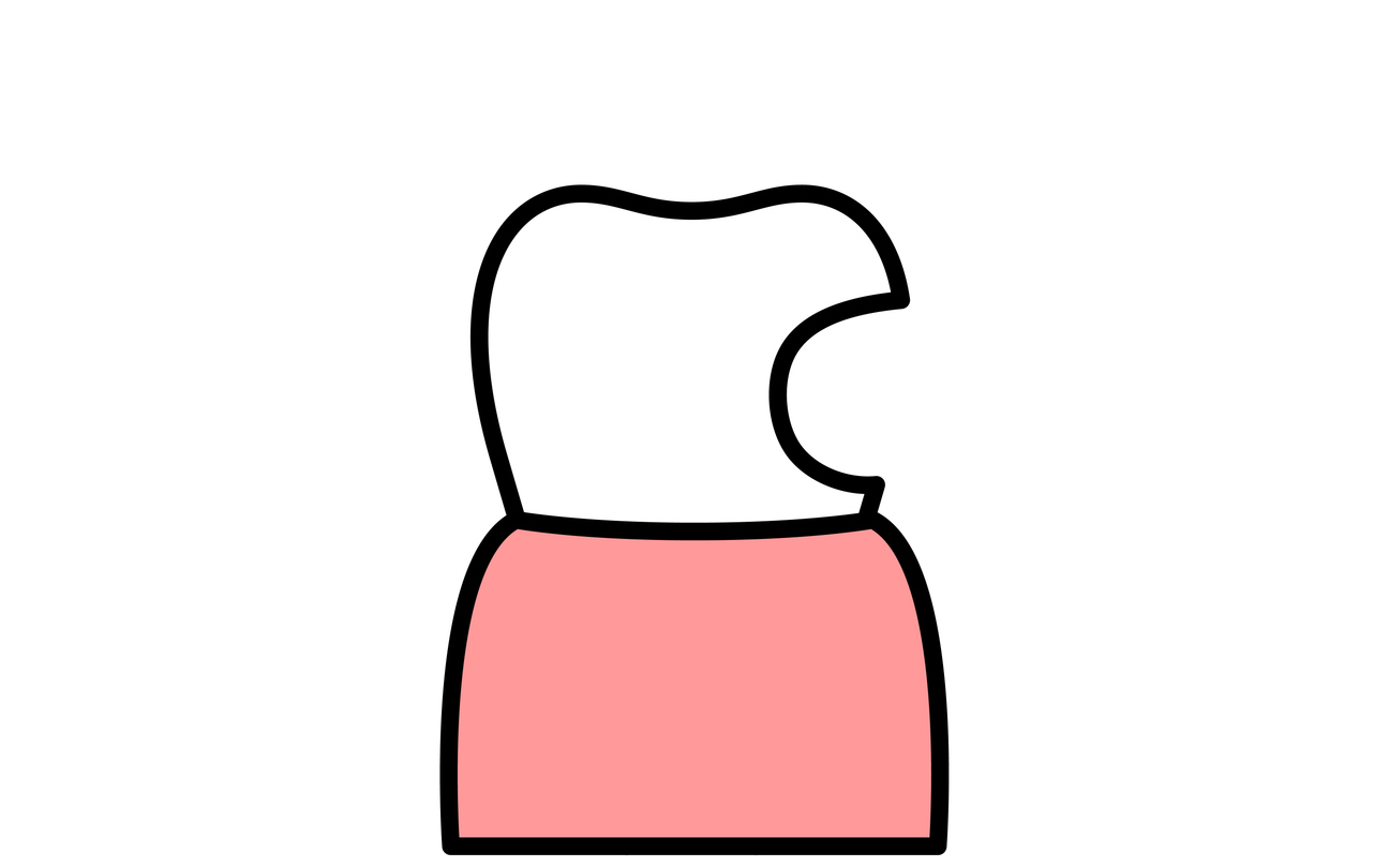 X線での肺の硬化