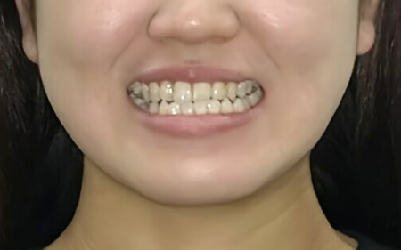 Before