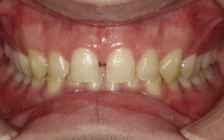 Before