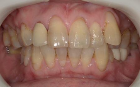 Before