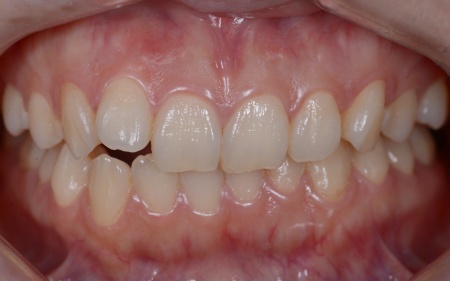 Before