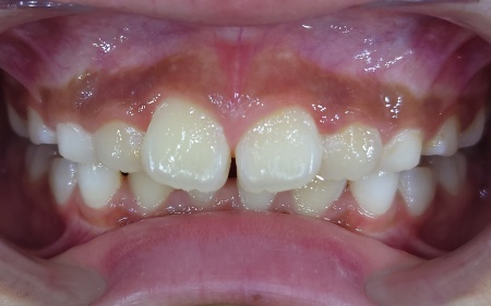 Before