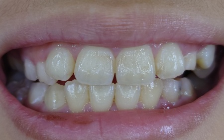 Before