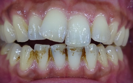 Before