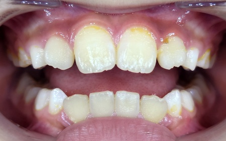 Before