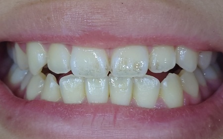 Before