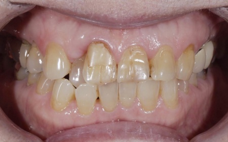 Before