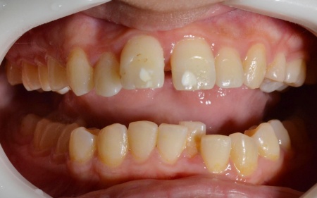 before