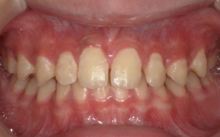Before