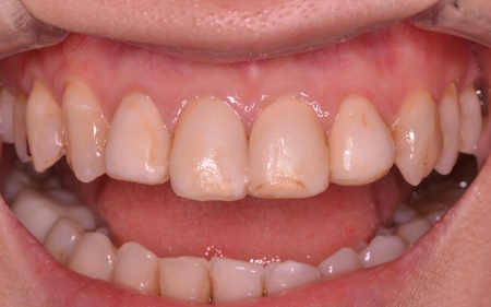 Before