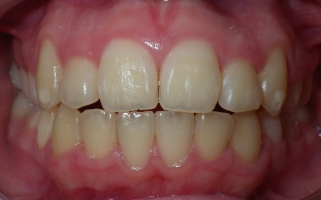 Before