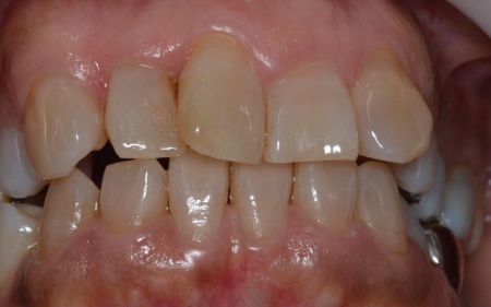 Before